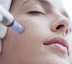microneedling training